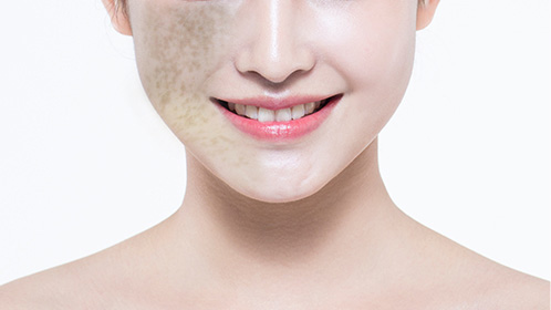 편측성 흑자증